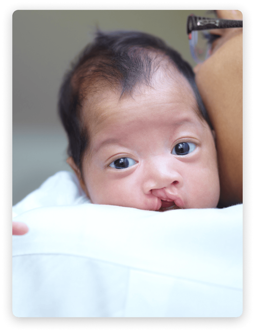 Labio y paladar hendido